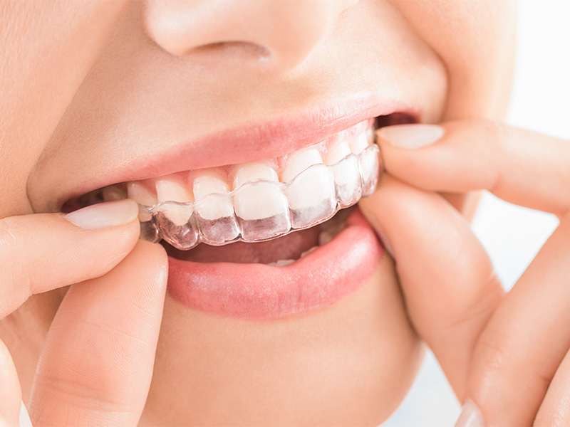 渋谷で働く人が“バレずに矯正する”方法